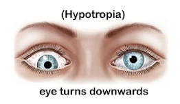 Hypertropia - Upward turning