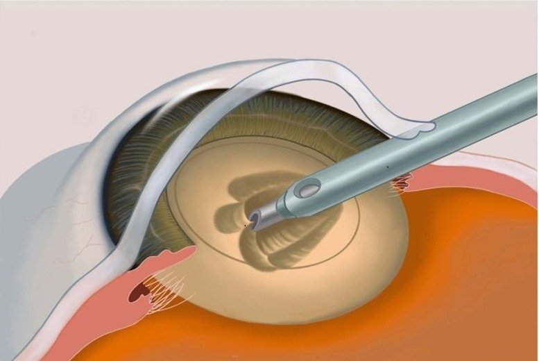 Best Cataract Surgeon in Nagpur